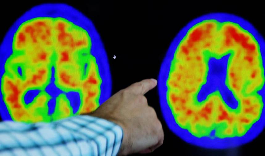  El efecto protector de la masa magra sobre el Alzheimer, salud. Foto: Reuters